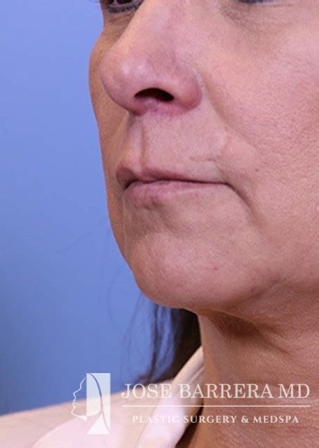 lip flip san antonio|Surgical Lip Lift in San Antonio, TX 